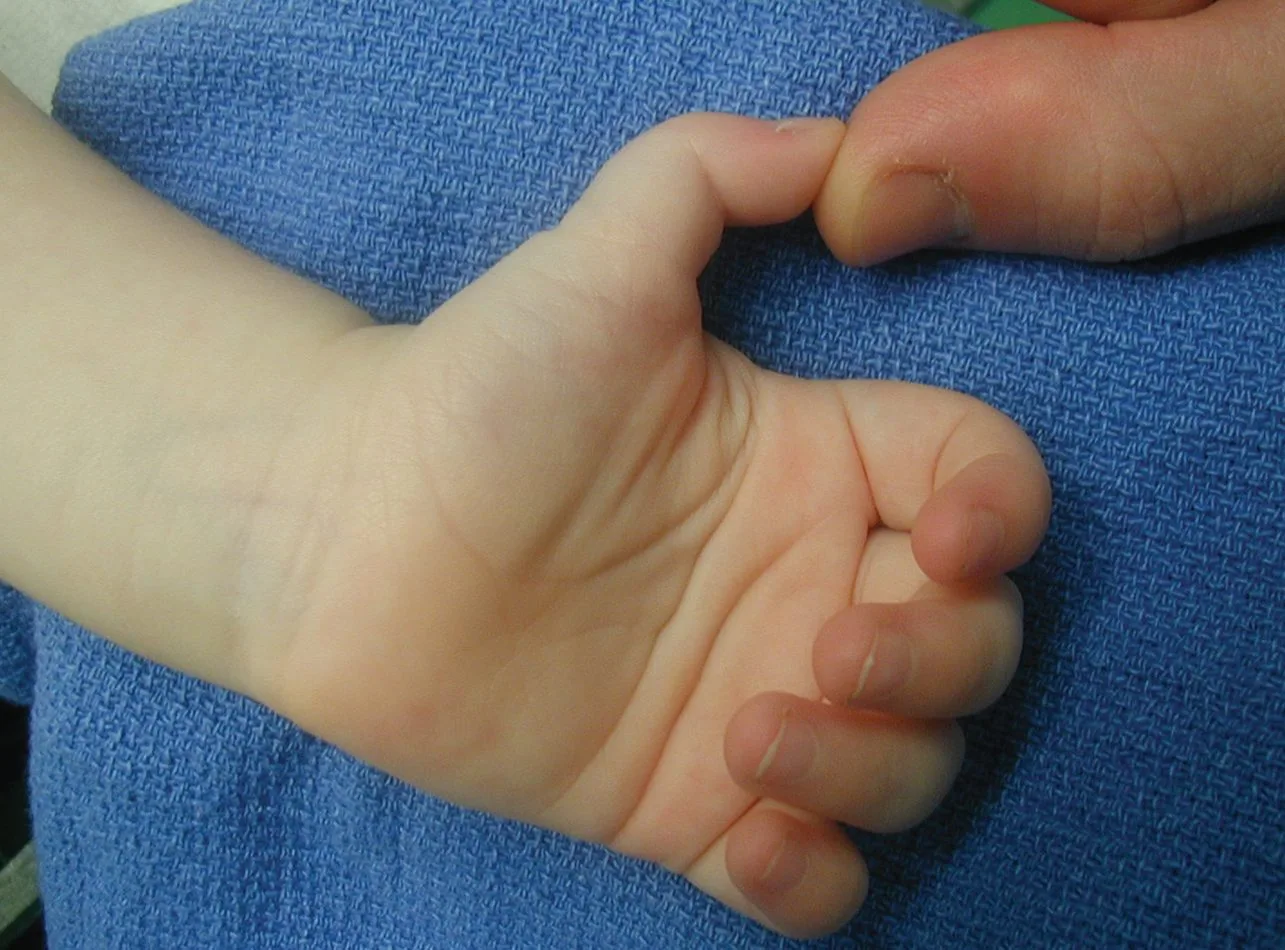 dr-mauricio-arouesty-proloterapia-que-es-el-pulgar-en-resorte-2
