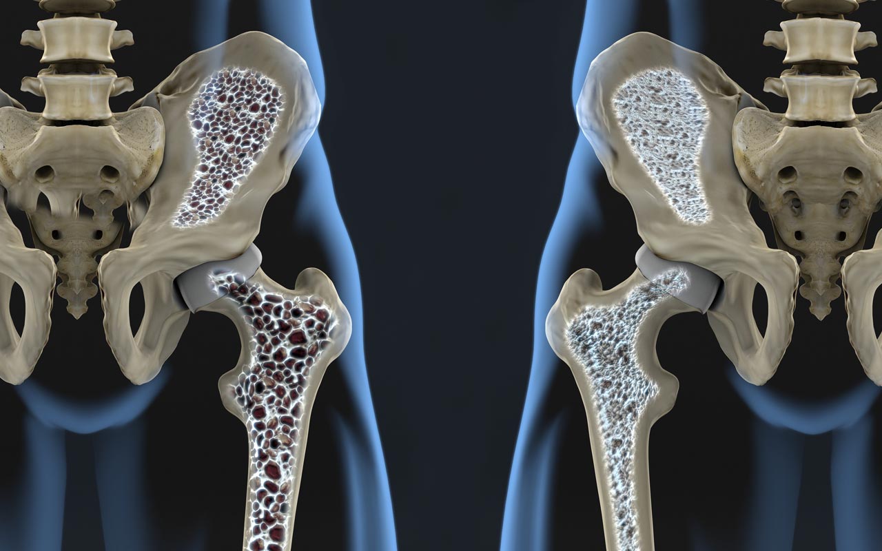 La osteoporosis debilita los huesos y aumenta la posibilidad de sufrir diferentes fracturas - Dr. Mauricio Arouesty