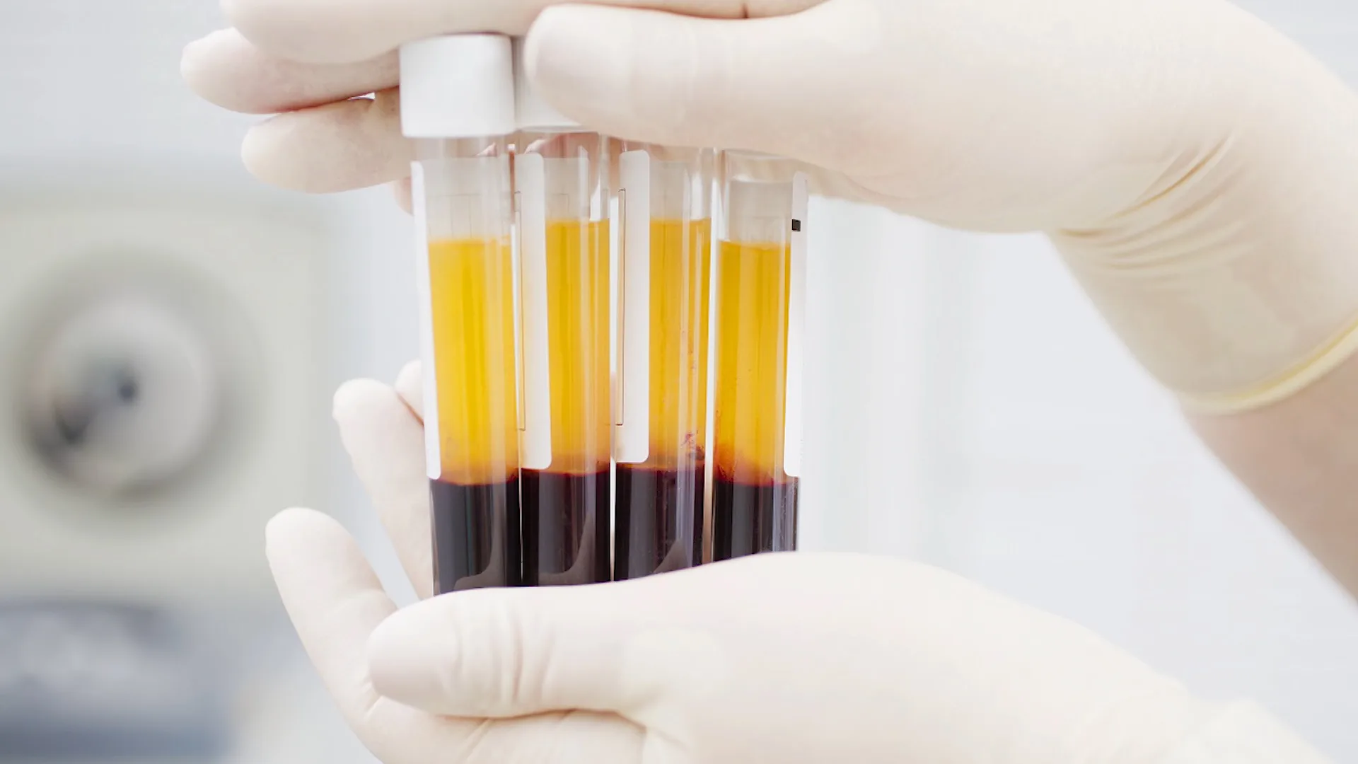 dr-mauricio-arouesty-proloterapia-que-es-el-plasma-rico-en-plaquetas-prp-2